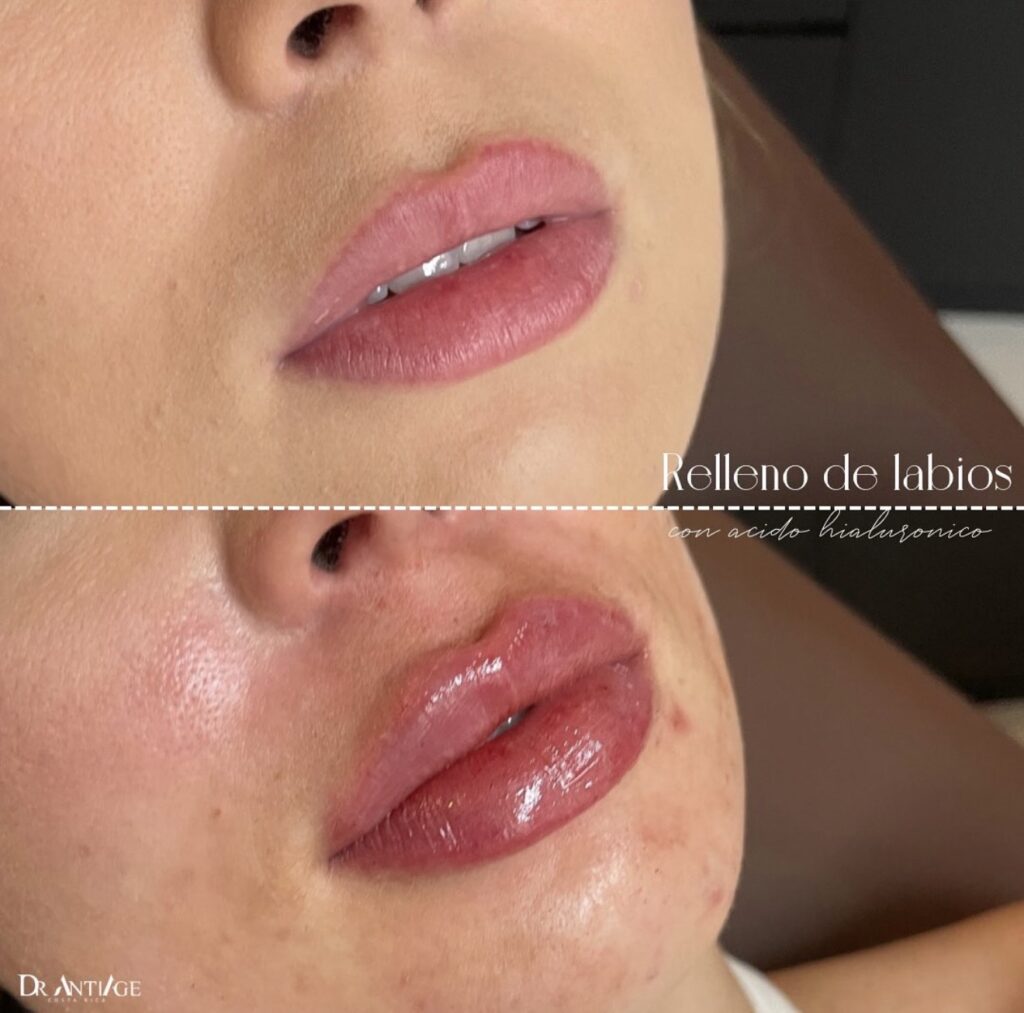 Relleno labios Medicina Estética
