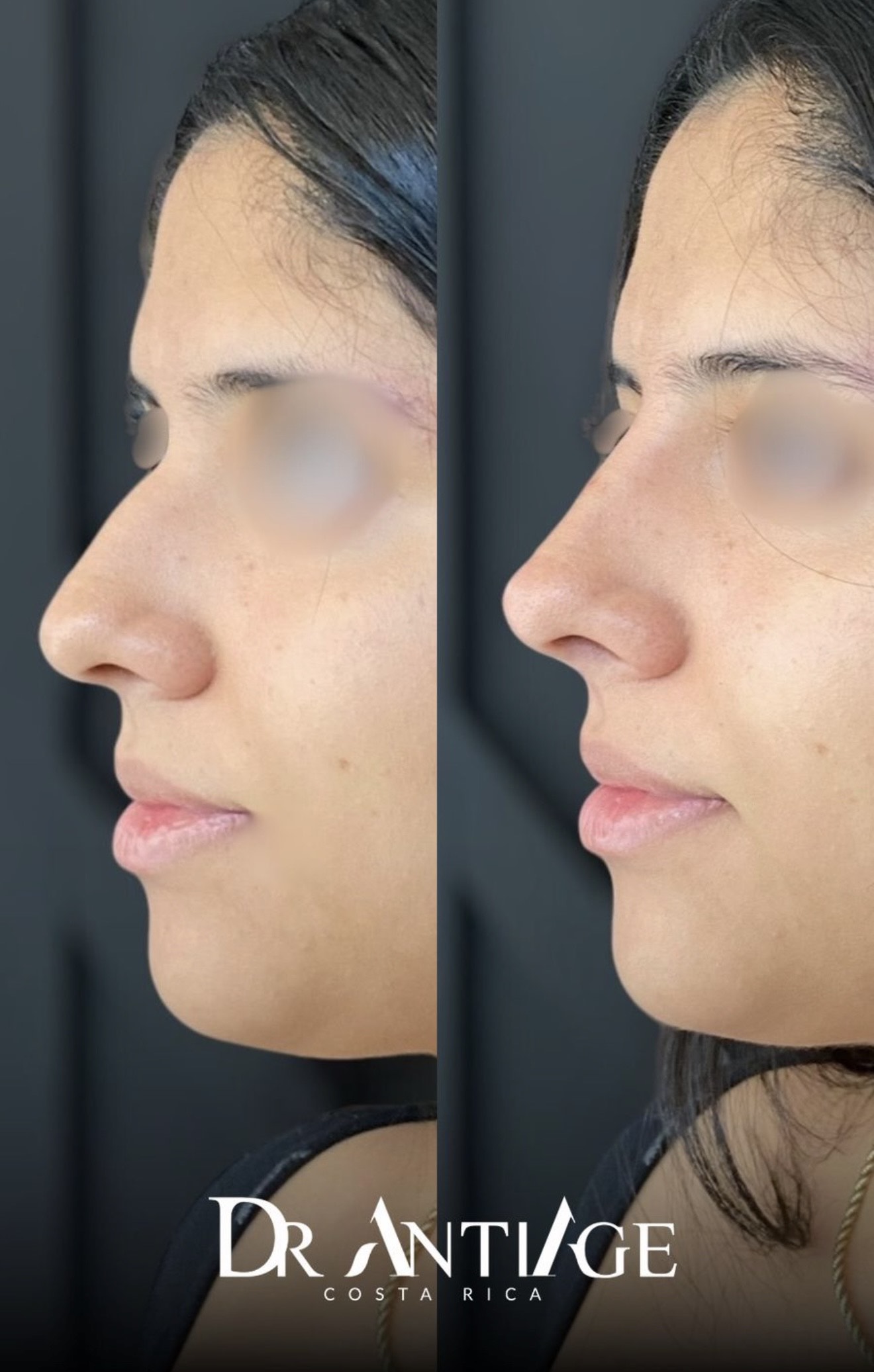 Armonización Facial