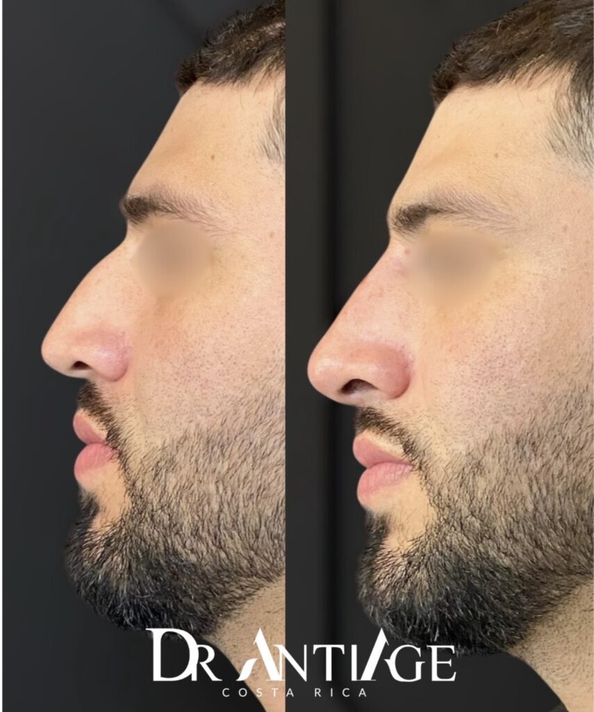 Armonización Facial