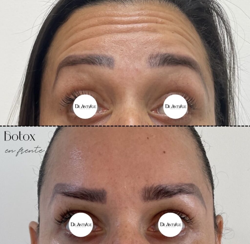 Botox